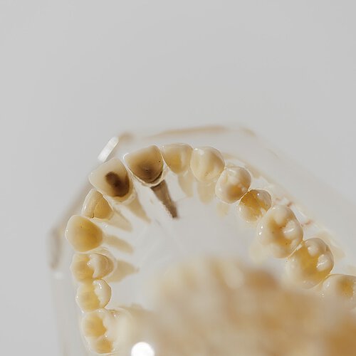Mit einer guten Mundhygiene kann dein Implantat 10 Jahre und länger halten.

Eine Studie der DGZMK stellte bei...